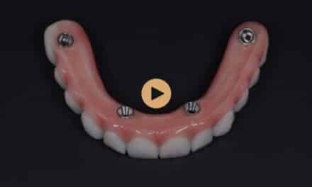 How Do All-On-4 Plus® Implants Differ From Traditional Dentures?