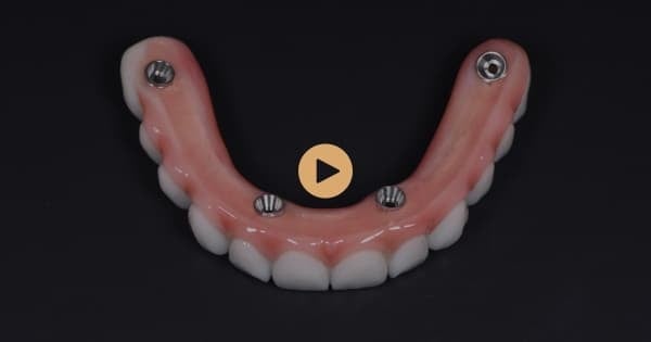 How Do All-On-4 Plus® Implants Differ From Traditional Dentures?