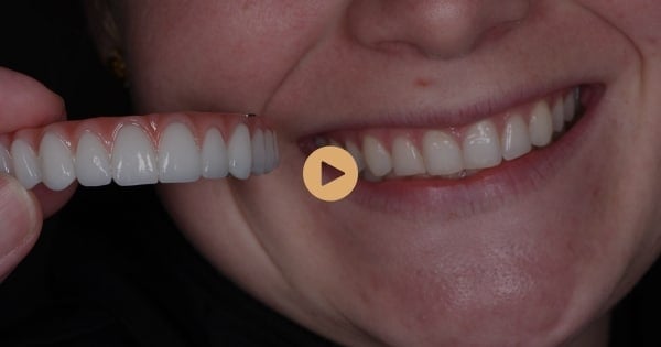 Is the All-On-4 Plus® Implants Procedure Suitable for Everyone?