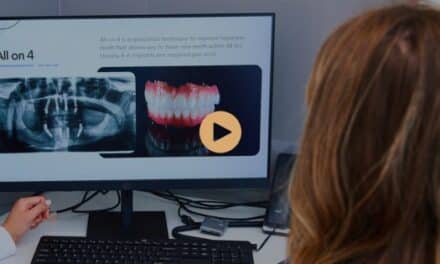 What Are All-On-4 Plus® Implants?