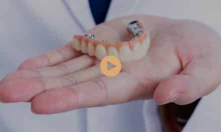 What Is the Success Rate of All-On-4 Plus® Implants?