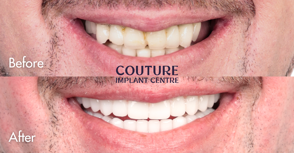 All-on-4 Plus Infected Implants Clinical Case In Melbourne