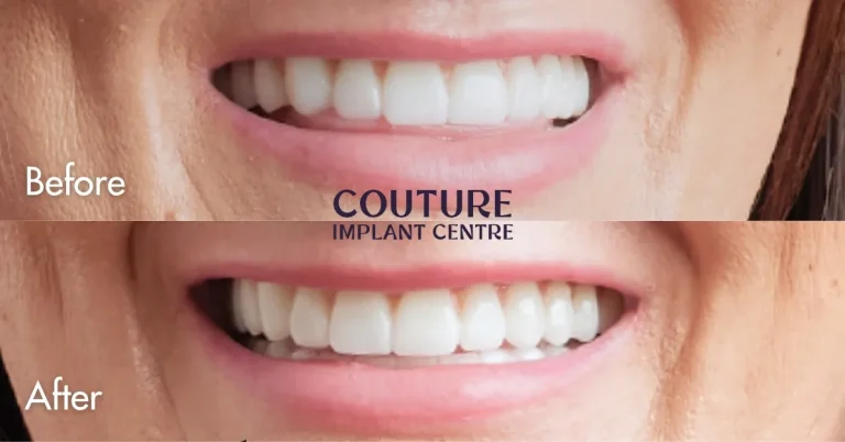 All-on-4 Plus Denture Replacement In Sunbury