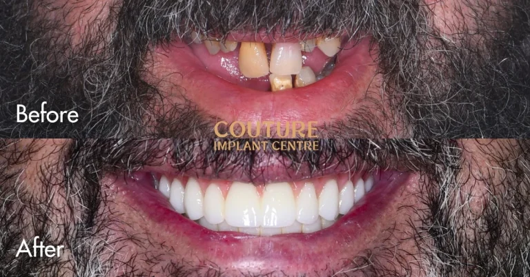 All-on-4 Plus Gum Disease Treatment In Sunbury