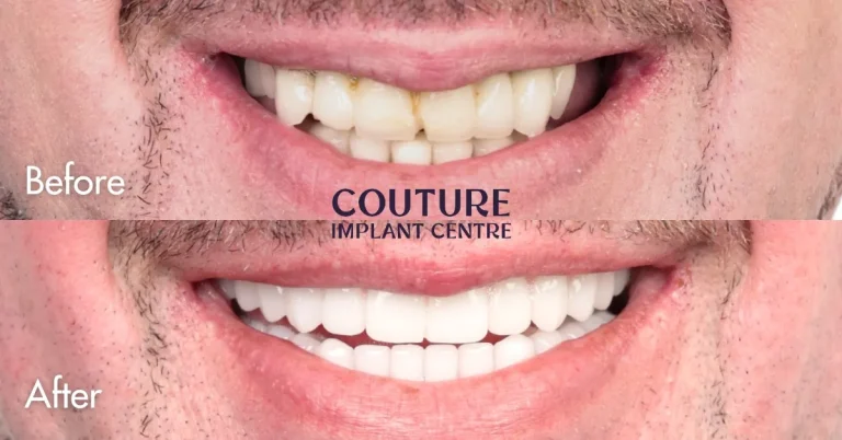 All-on-4 Plus Infected Implants Clinical Case In Melbourne