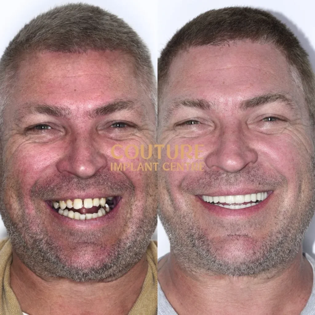 All-on-4 Plus dental implant patient from Melbourne at Couture Implant Centre