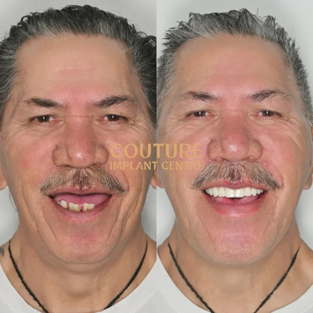 All-on-4 Plus dental implant patient from Melbourne at Couture Implant Centre