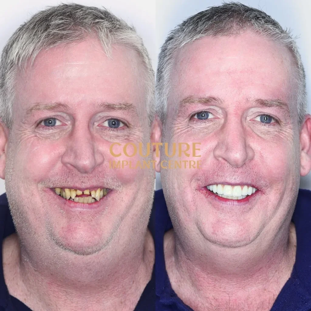 All-on-4 Plus dental implant patient from Gisborne at Couture Implant Centre