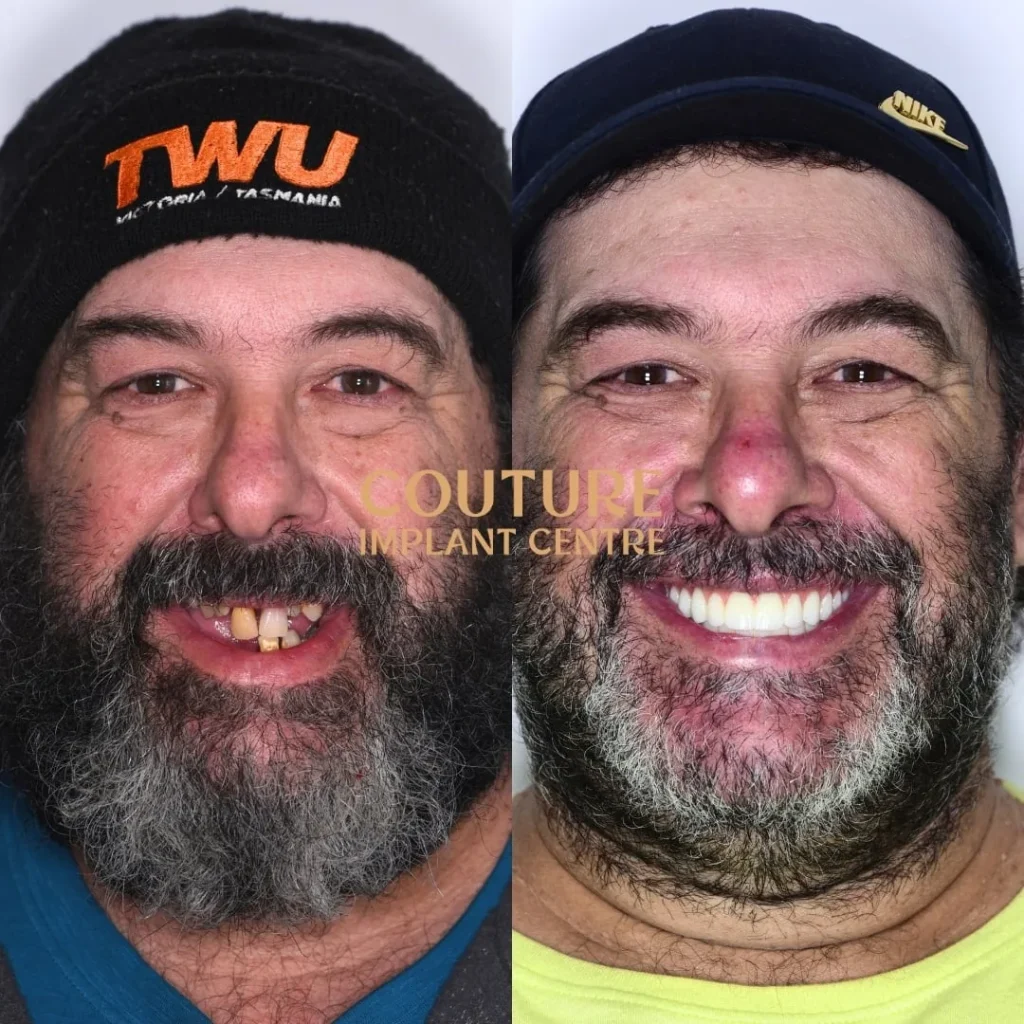 All-on-4 Plus dental implant patient from Sunbury at Couture Implant Centre