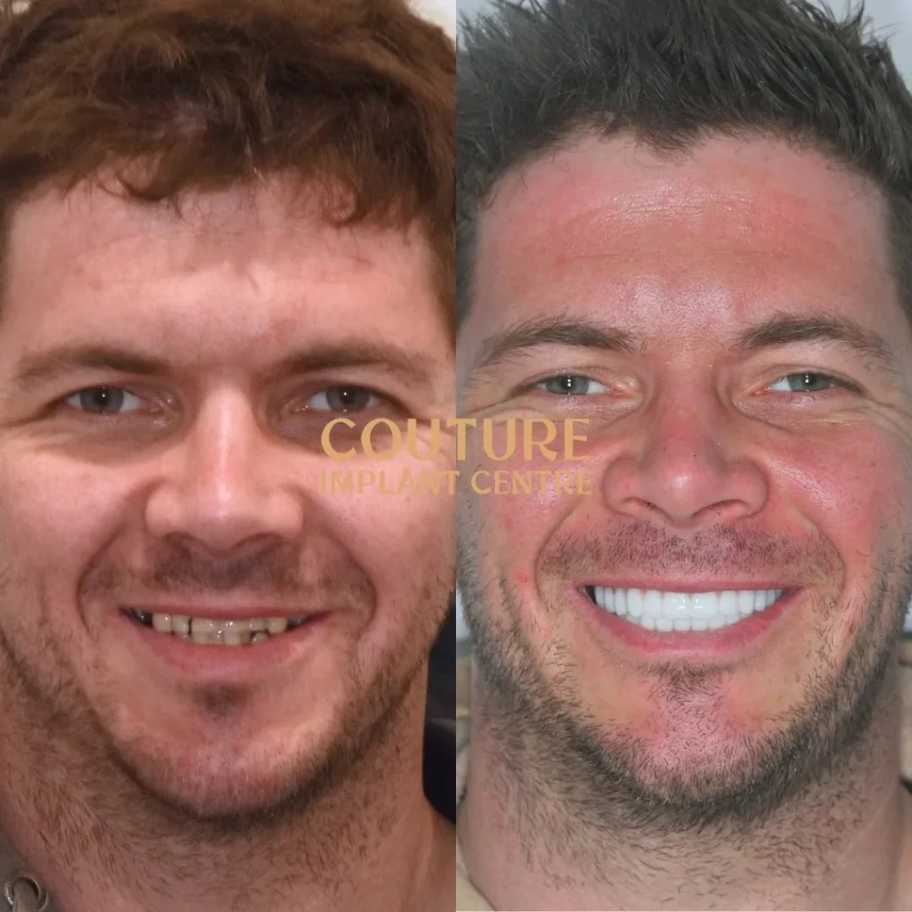 All-on-4 Plus dental implant patient from Bacchus Marsh at Couture Implant Centre