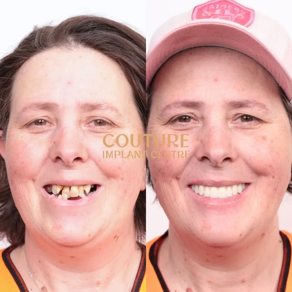 All-on-4 Plus dental implant patient from Sunbury at Couture Implant Centre