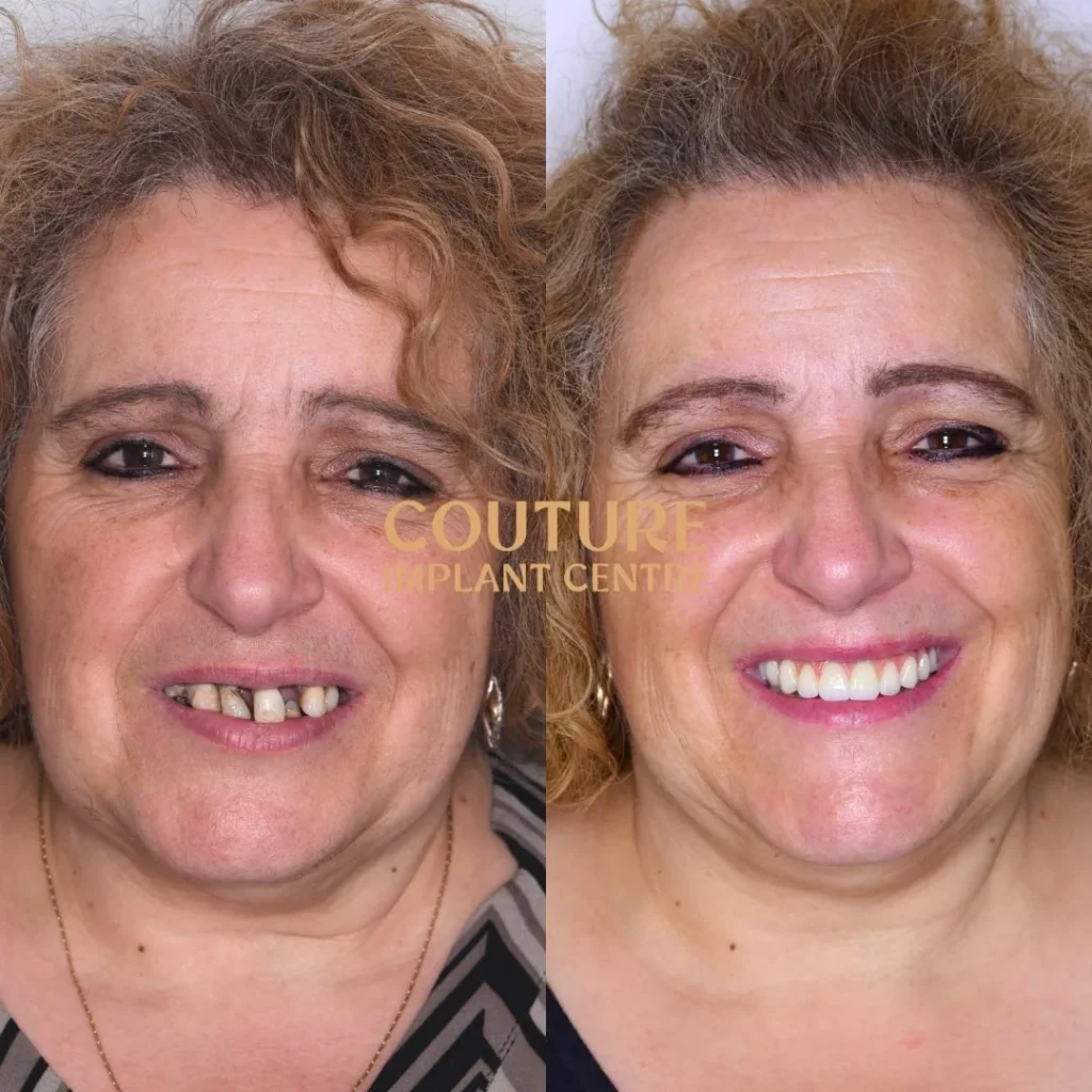 All-on-4 Plus dental implant patient from Melton at Couture Implant Centre