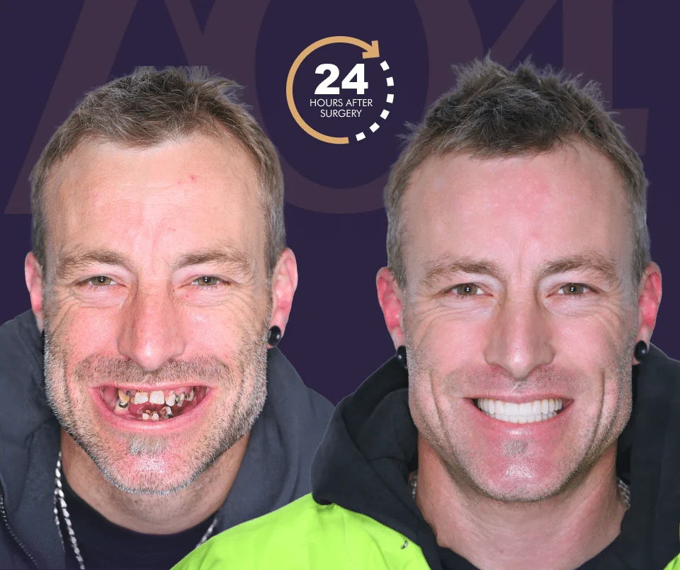 Couture Implant Centre patient before and 24 hours after All-on-4 Plus implant surgery