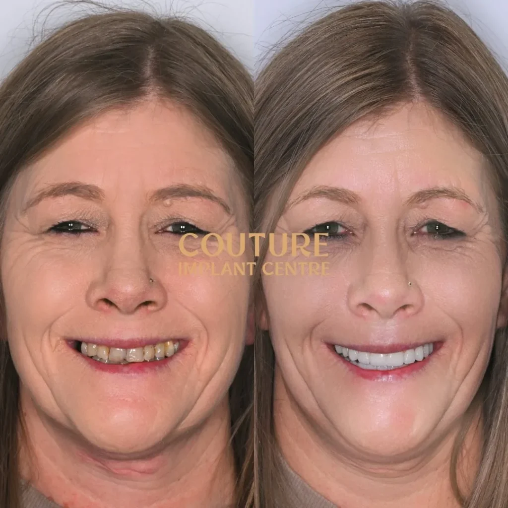 All-on-4 Plus dental implant patient from Melton at Couture Implant Centre