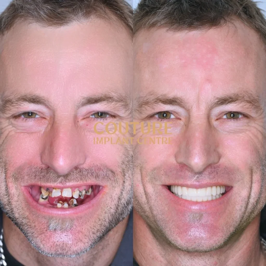 All-on-4 Plus dental implant patient from Melton at Couture Implant Centre
