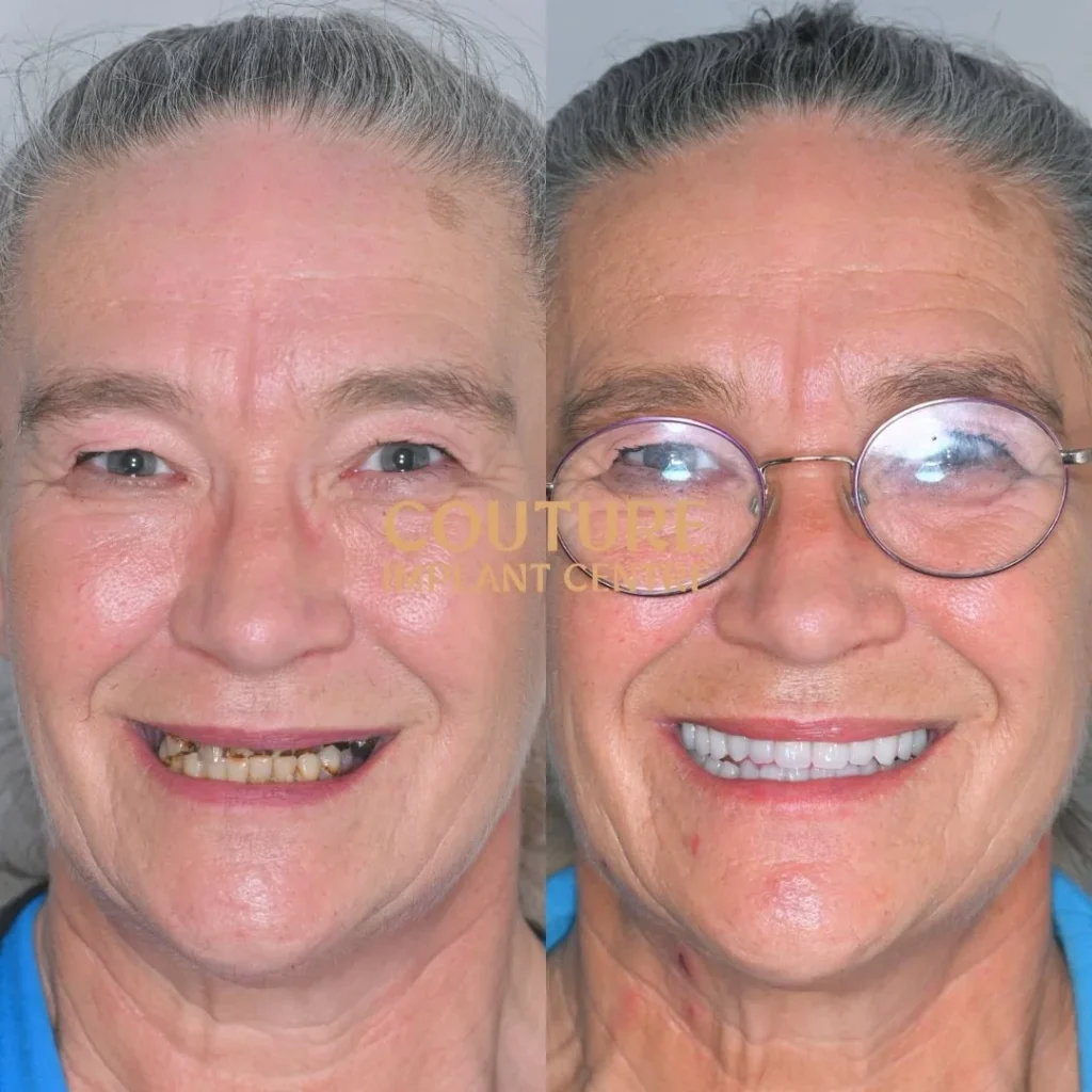All-on-4 Plus dental implant patient from Melbourne at Couture Implant Centre