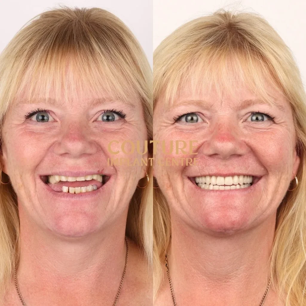 All-on-4 Plus dental implant patient from Melton at Couture Implant Centre