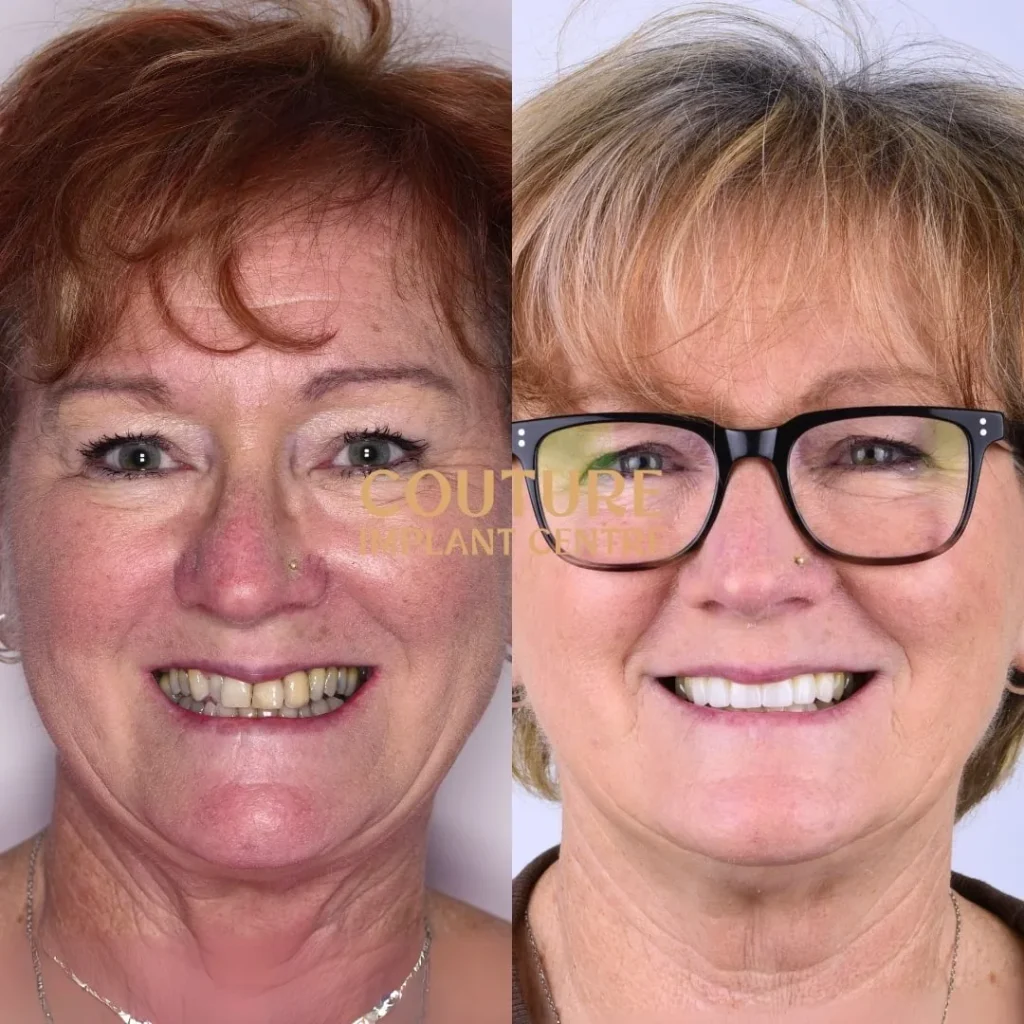 All-on-4 Plus dental implant patient from Melton at Couture Implant Centre
