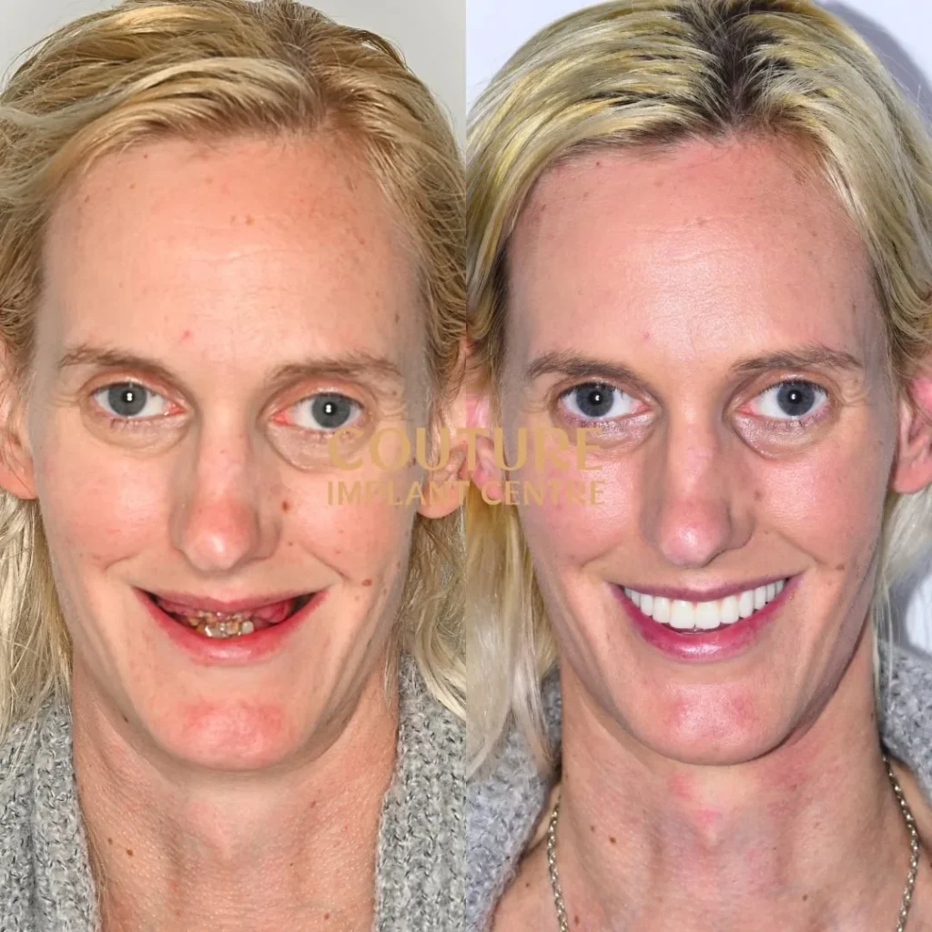 All-on-4 Plus dental implant patient from Sunbury at Couture Implant Centre