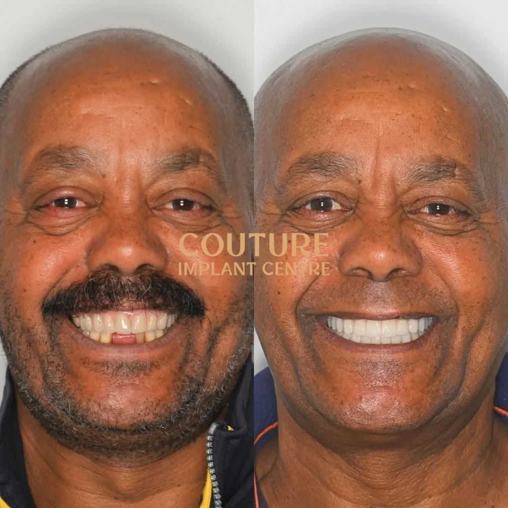 All-on-4 Plus dental implant patient from Sunbury at Couture Implant Centre