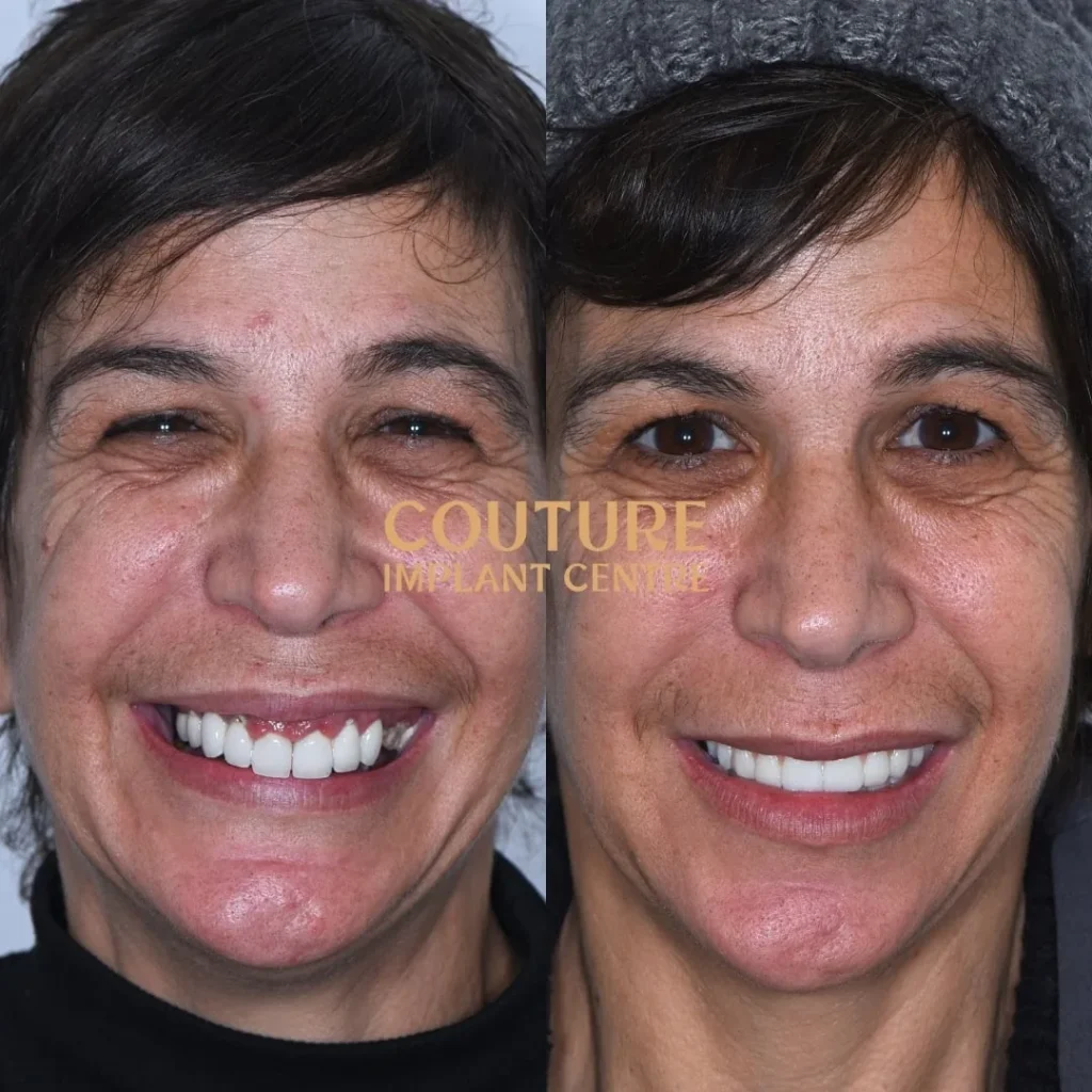All-on-4 Plus dental implant patient from Melbourne at Couture Implant Centre