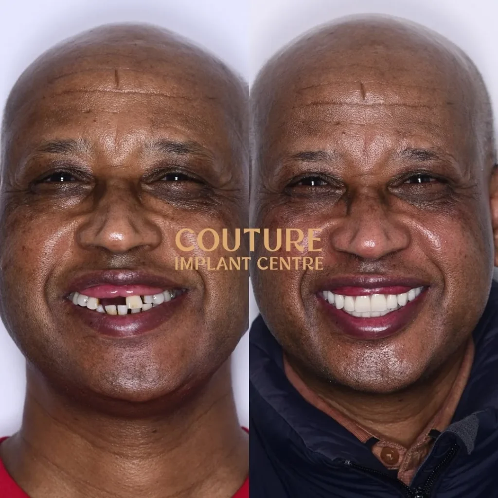 All-on-4 Plus dental implant patient from Melbourne at Couture Implant Centre