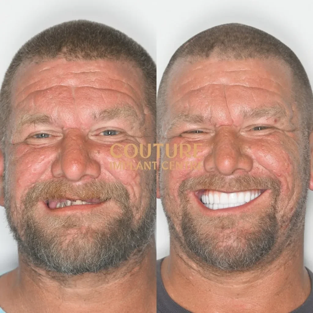 All-on-4 Plus dental implant patient from Melbourne at Couture Implant Centre