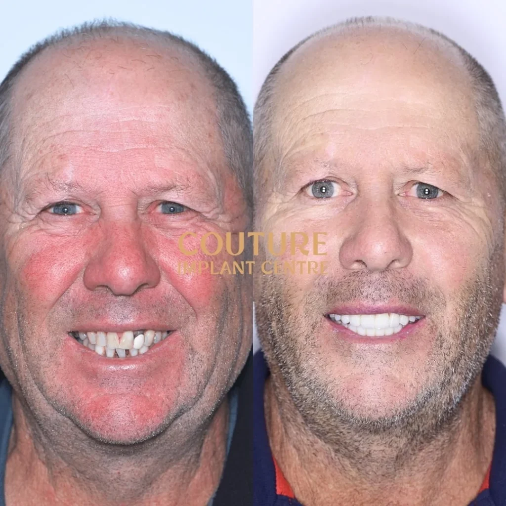 All-on-4 Plus dental implant patient from Melton at Couture Implant Centre