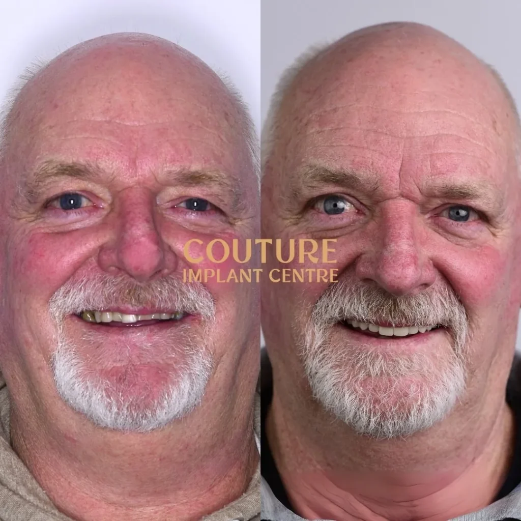 All-on-4 Plus dental implant patient from Melton at Couture Implant Centre
