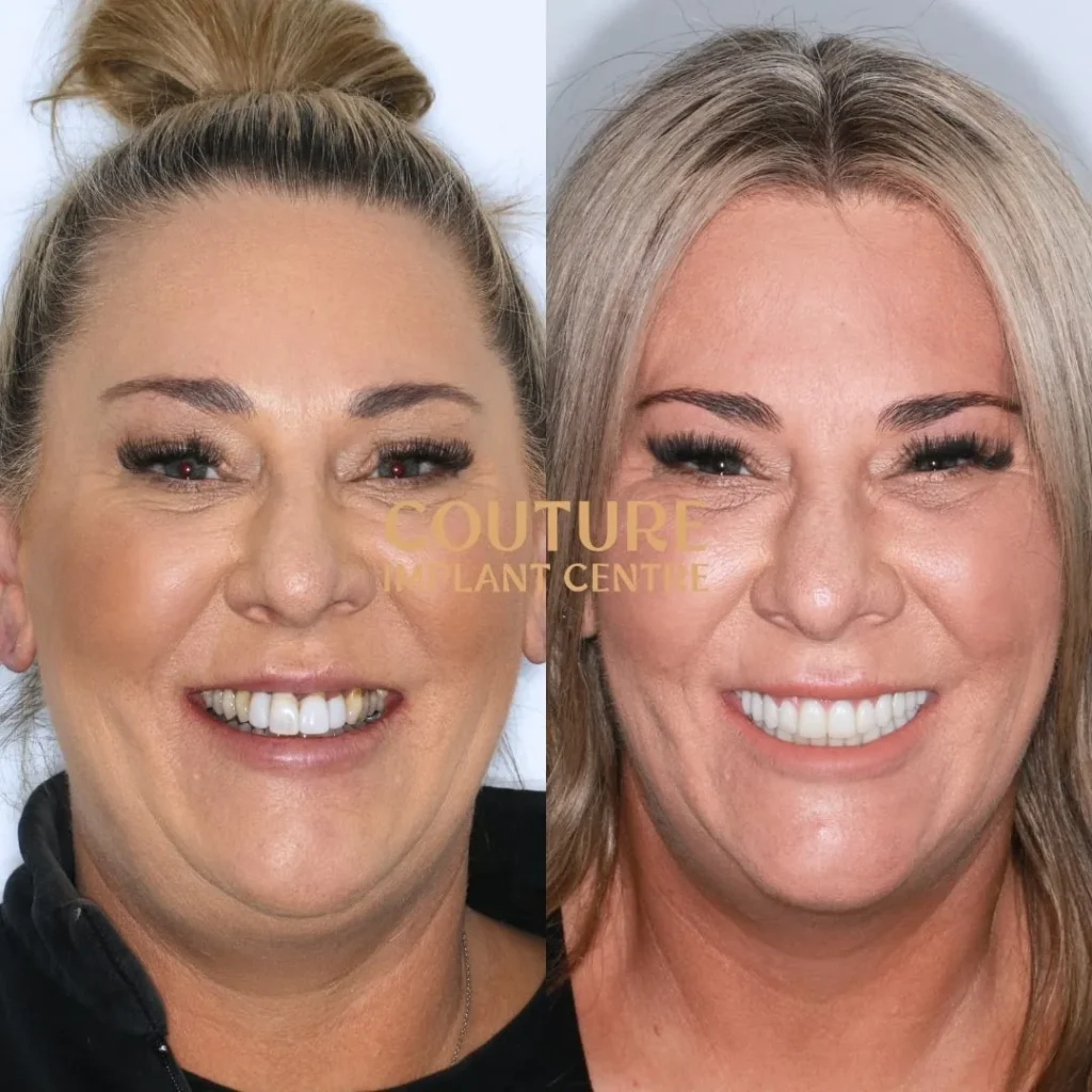 All-on-4 Plus dental implant patient from Bacchus Marsh at Couture Implant Centre