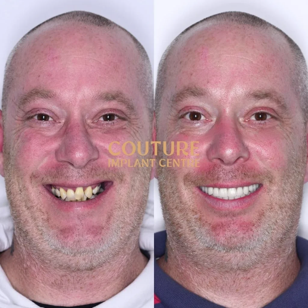 All-on-4 Plus dental implant patient from Melton at Couture Implant Centre