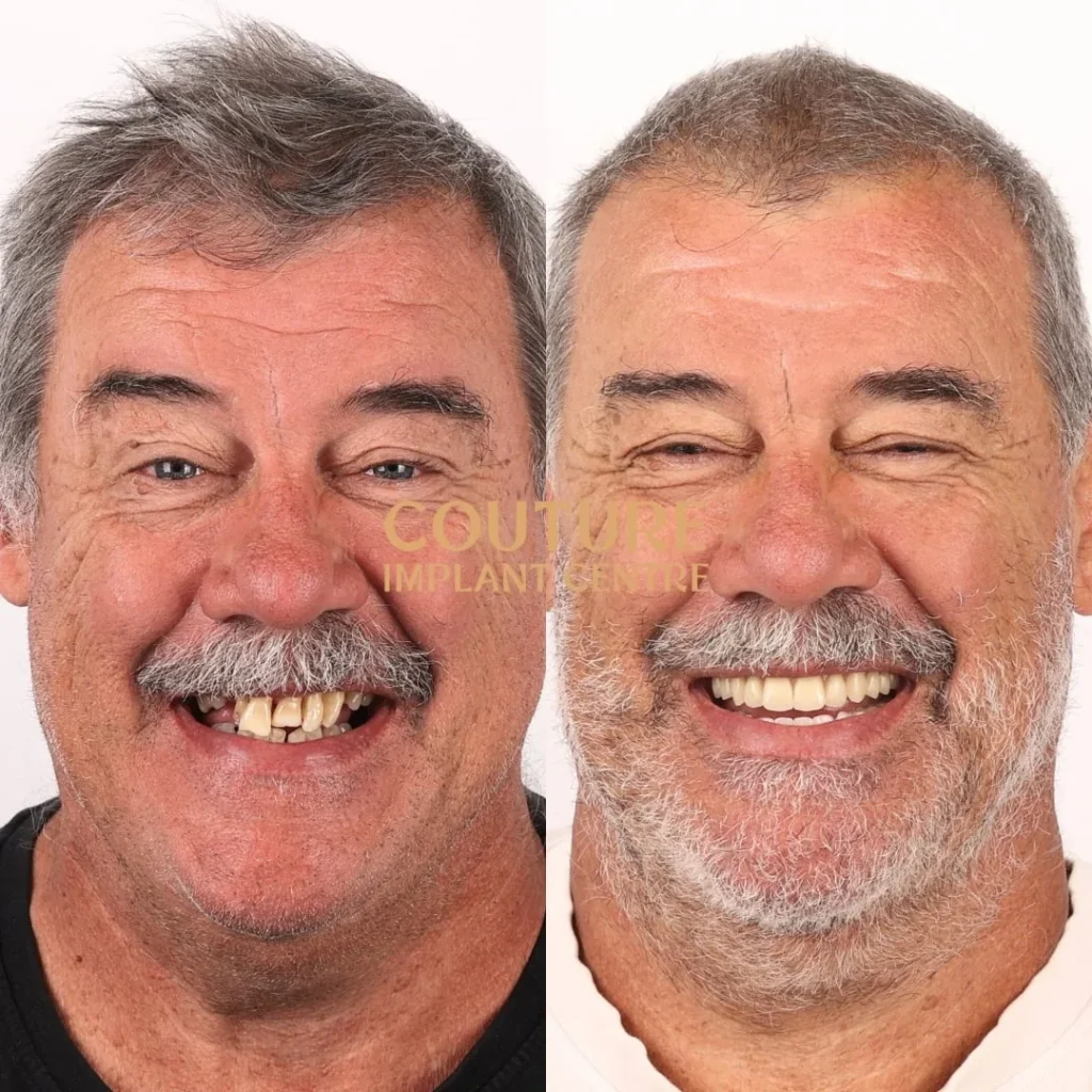 All-on-4 Plus dental implant patient from Melton at Couture Implant Centre