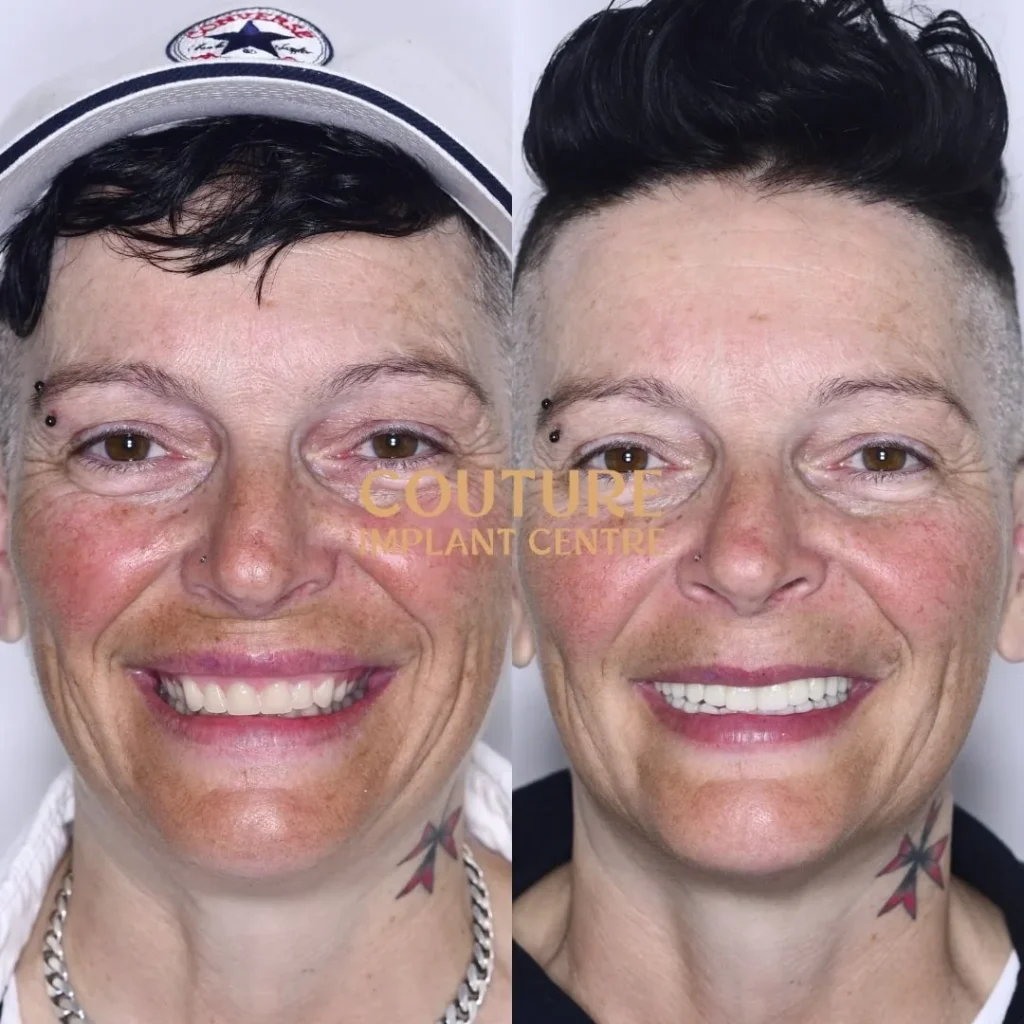 All-on-4 Plus dental implant patient from Melton at Couture Implant Centre