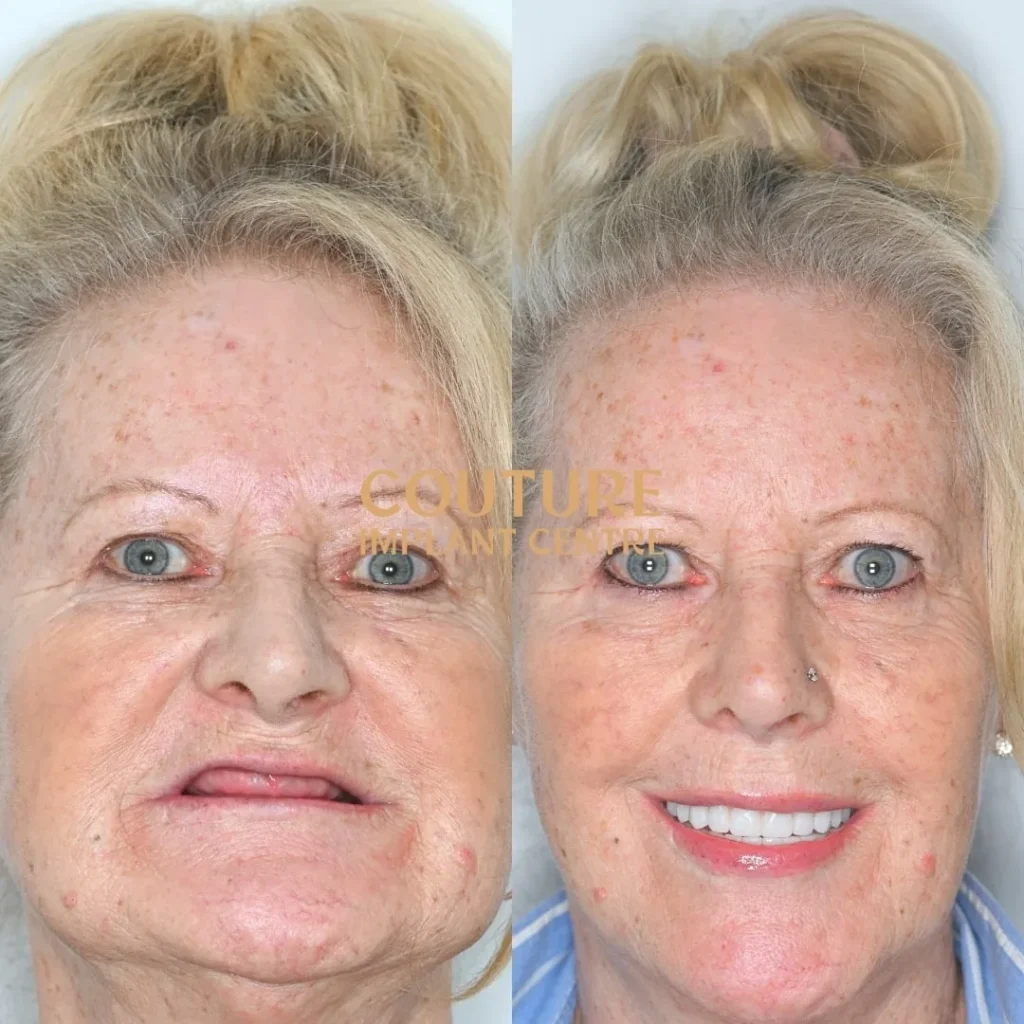 All-on-4 Plus dental implant patient from Bacchus Marsh at Couture Implant Centre