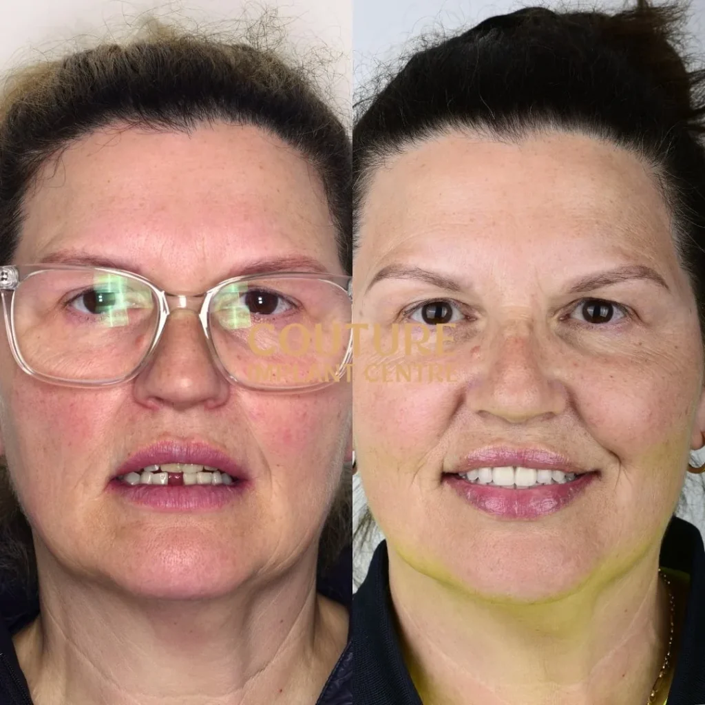 All-on-4 Plus dental implant patient from Melton at Couture Implant Centre