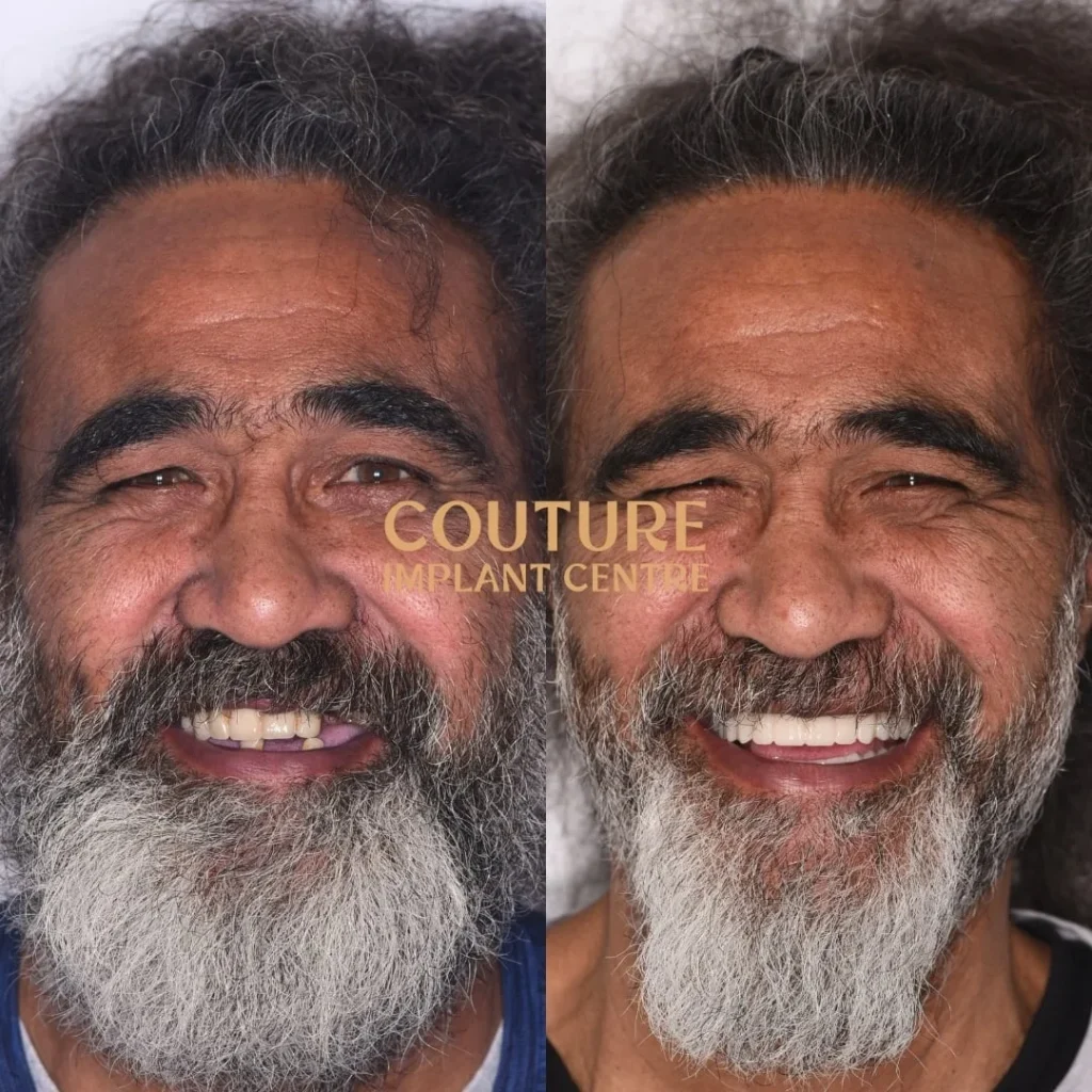 All-on-4 Plus dental implant patient from Sunbury at Couture Implant Centre